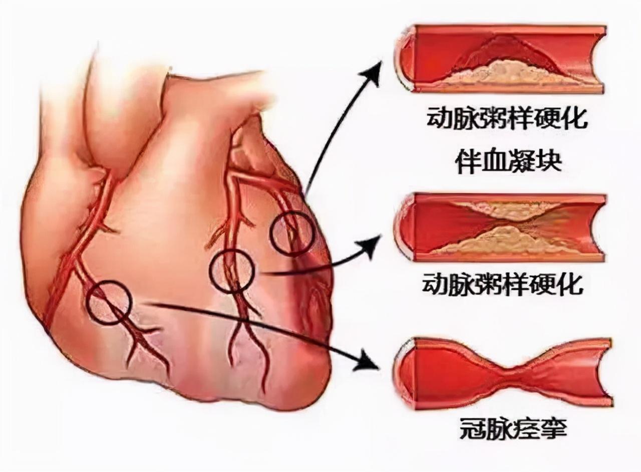 冠心病最新诊断标准,冠心病最新诊断标准概述